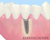 インプラントとは