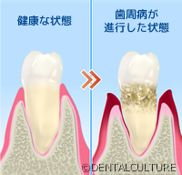 歯周病とは？